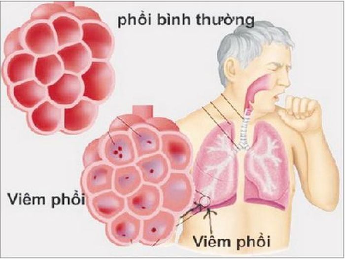 Rau dấp cá ép lấy nước hỗ trợ điều trị bệnh phổi.