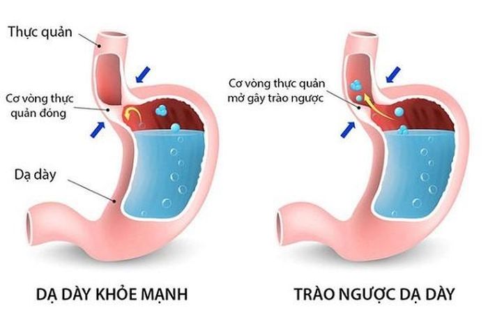 Trào ngược dạ dày - thực quản là một nguyên nhân gây ho khan.