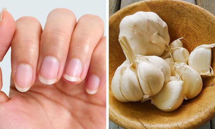 Tỏi cũng chứa nhiều thành phần có tính kháng khuẩn, ngăn vi khuẩn, nấm phát triển. Hãy nghiền nát vài tép tỏi tươi sau đó đặt chúng lên vùng móng nhiễm nấm. Kiên trì với cách này hàng ngày sẽ giúp vùng khóe móng nhanh phục hồi, khỏe mạnh trở lại. Ảnh: BS.