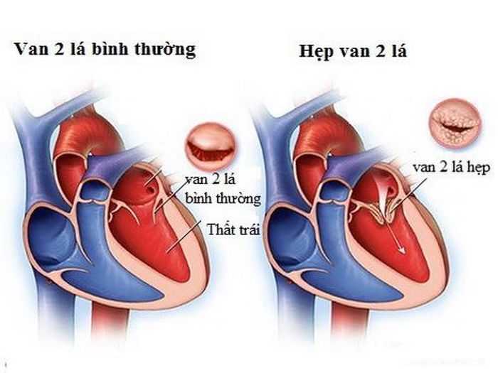 Hình ảnh hẹp van hai lá.