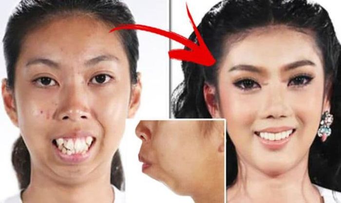  Wijitpraphorn Punbu, 22 tuổi, đến từ Thái Lan, tiết lộ cô đối mặt với nhiều năm bị bắt nạt vì sinh ra với gương mặt kém xinh đẹp, hàm răng hô. “Trước khi phẫu thuật, tôi có cuộc sống buồn tẻ và cô đơn. Mọi người luôn trêu chọc tôi và điều đó thật đau đớn”, cô tâm sự. Sau khi được chọn tham gia chương trình phẫu thuật thẩm mỹ và tới Hàn Quốc để chỉnh sửa, Wijitpraphorn Punbu đã có sự thay đổi đáng kinh ngạc. 