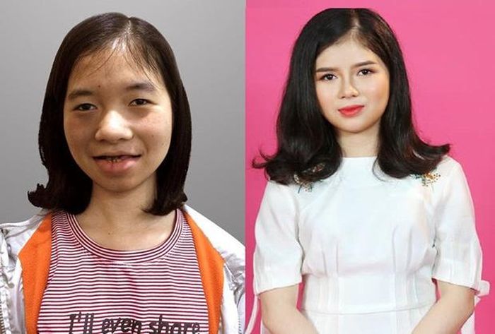  Ngoài Vũ Thanh Quỳnh, nhiều cô gái cũng thay đổi diện mạo của mình đến mức khán giả khó có thể nhận ra thông qua các chương trình truyền hình với chủ đề phẫu thuật thẩm mỹ. Phạm Thị Hà đến từ Quảng Bình tâm sự cô thường xuyên bị bạn bè gọi là “ma cà rồng” vì ngoại hình. Trước những lời cay đắng từ dư luận, cô gái quyết tâm phẫu thuật thẩm mỹ. Để có cuộc lột xác, cô gái trải qua 5 lần phẫu thuật suốt 108 ngày đầy đau đớn. Hiện tại, cô gái 22 tuổi đã tự tin hơn với nhan sắc của mình. 
