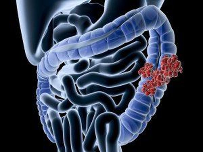 Vi khuẩn E.coli co thể gây ung thư ruột kết.