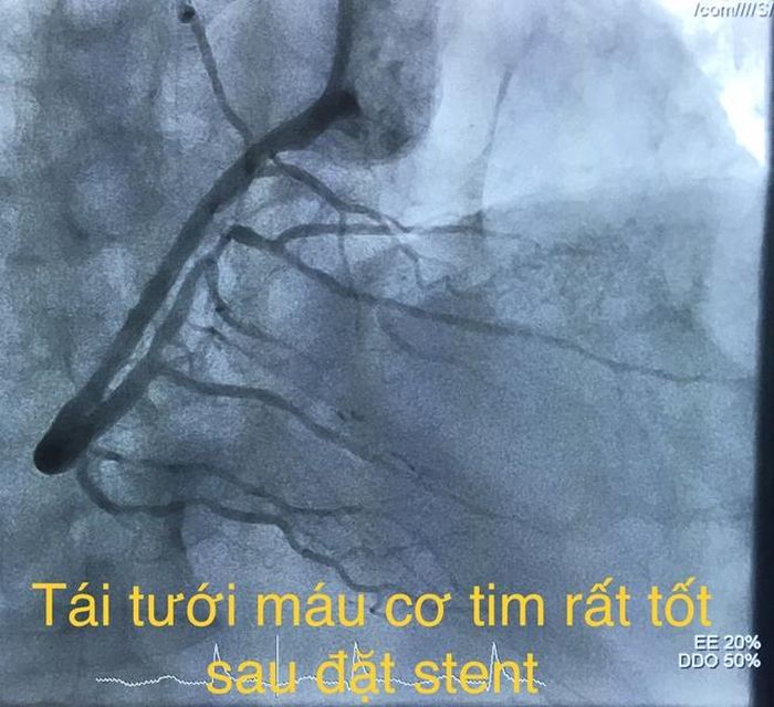 Và sau khi được tái thông. 