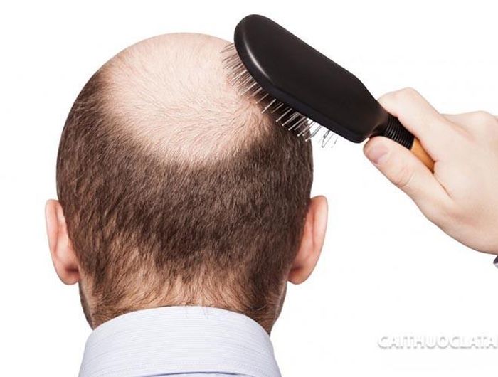  Do đó, hãy bỏ thuốc lá nhanh nhất có thể. Bỏ thuốc không chỉ giúp bạn tránh khỏi tình trạng rụng tóc mà còn giúp bạn có một sức khỏe tốt hơn 