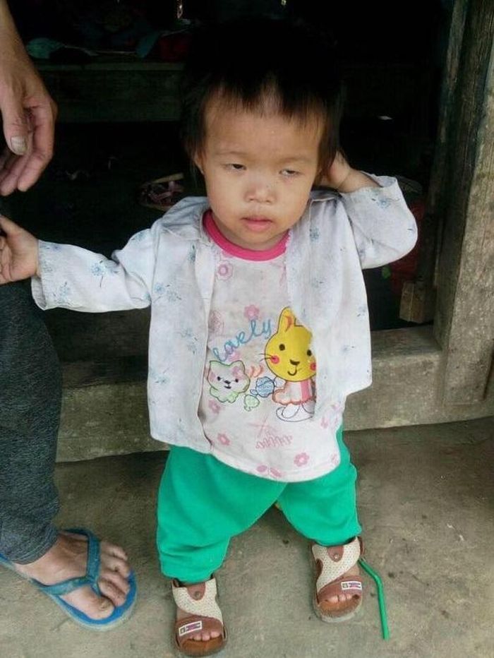 Con gái út của vợ chồng anh Phượng bị u máu trong gan và suy dinh dưỡng