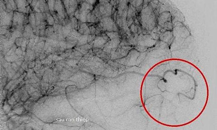 Mạch máu sau can thiệp