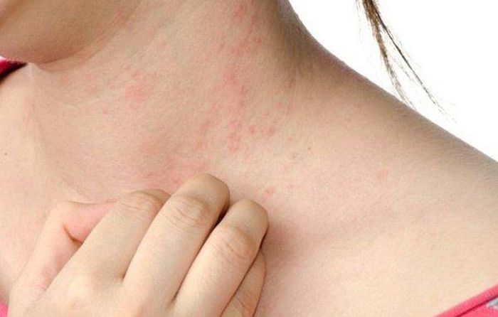 Hình ảnh sẩn ngứa.