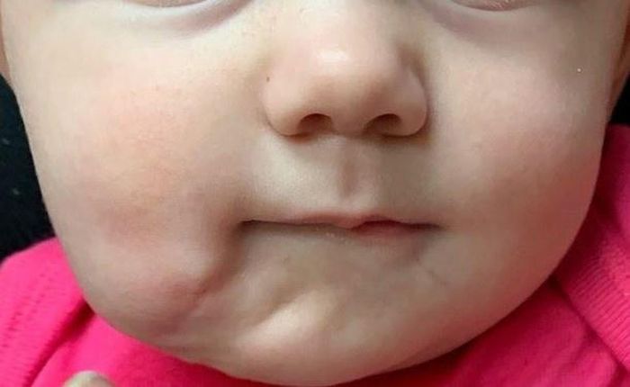  Bé gái hồi phục sau một thời gian phẫu thuật. Ảnh: BMJ. 