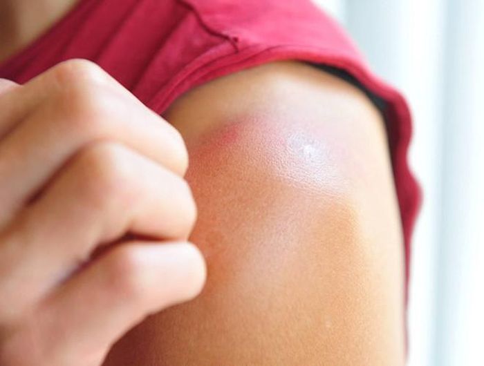  Bạn cũng có thể pha giấm táo với nước, cho vào một bình xịt và xịt lên các vùng bị cháy nắng để làm giảm ngứa rát và đau. Chú ý tránh xịt vào mắt và những vết thương hở 