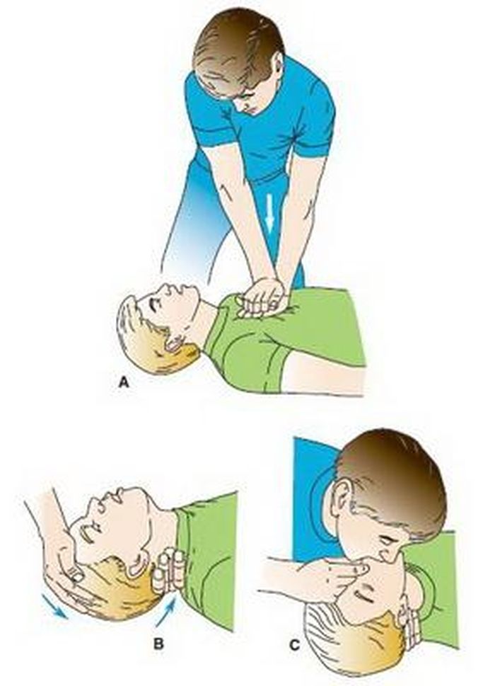 Các bước chính trong hồi sức tim phổi.