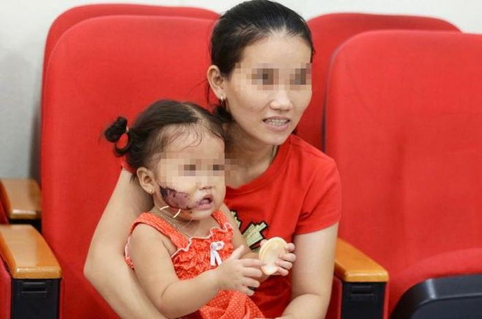 Bé gái ở Tây Ninh bị chó cắn dập nát vùng má phải khi đến gần con vật. Ảnh: BH.