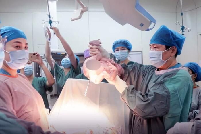 Khoảnh khắc các bác sĩ đón Tongtong trong ca sinh mổ.