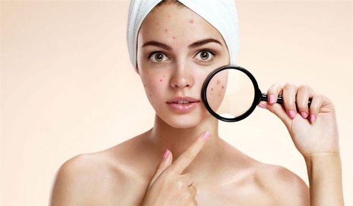 Đừng chạm vào nốt mụn:Thói quen tưởng như vô hại này sẽ khiến mụn sưng đỏ hơn. Trong trường hợp mụn phồng lớn và chuẩn bị vỡ, chị em dùng bông tăm ấn nhẹ để phần bã nhờn tự bung ra. Sau đó, bạn hãy nhỏ vài giọt thuốc nhỏ mắt nhằm rửa sạch vết thương. Ảnh:blibli.