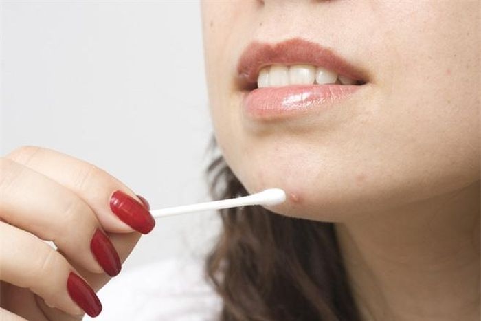 Thử dùng thuốc nhỏ mắt visine:Sự thật bất ngờ là thuốc nhỏ mắt có khả năng kháng viêm, giảm tình trạng ửng đỏ. Trước tiên, chị em nhỏ vài giọt vào đầu tăm bông và chấm nhẹ lên chỗ mụn. Bạn cần kiên trì sử dụng cách này, sau 2-3 ngày sẽ thấy rõ kết quả. Ảnh:vix.
