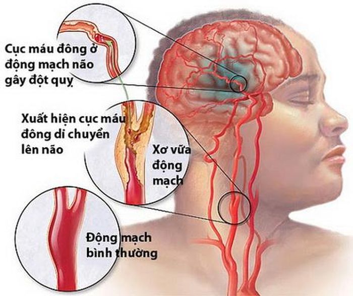 Bệnh nhân bị xơ vữa nặng các động mạch não có nguy cơ tái phát đột quỵ.