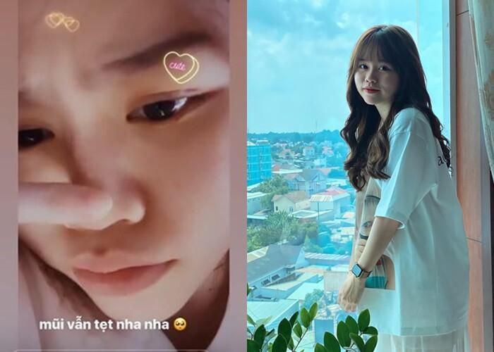 Mũi của Huỳnh Anh khá thấp so với những người đã qua phẫu thuật