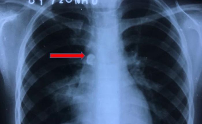 Hình ảnh X-quang phổi cho thấy dị vật nằm bên phải cạnh cột sống