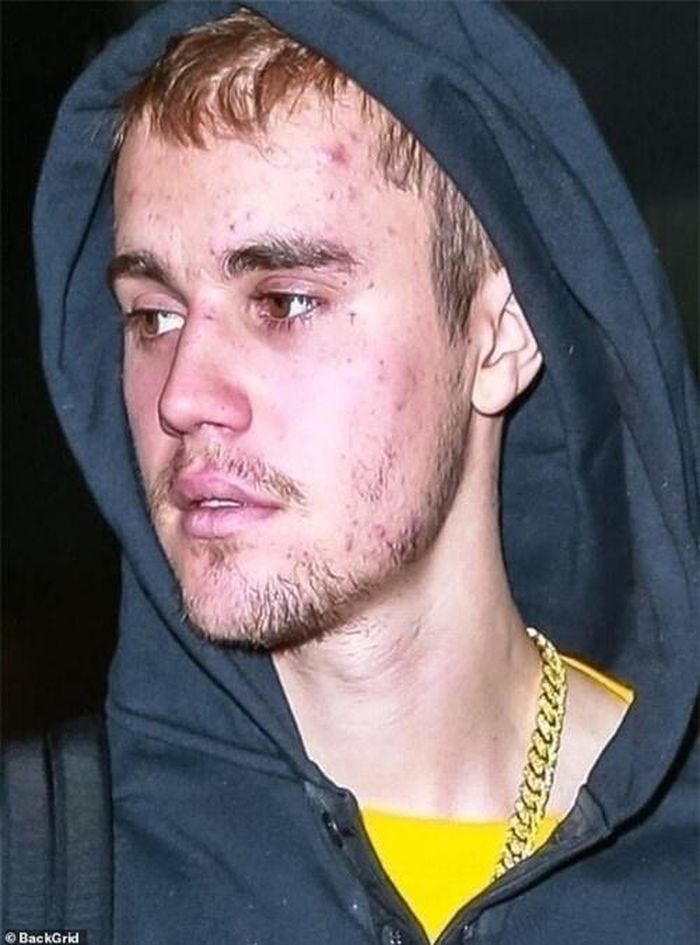 Làn da của Justin Bieber trong quá khứ.