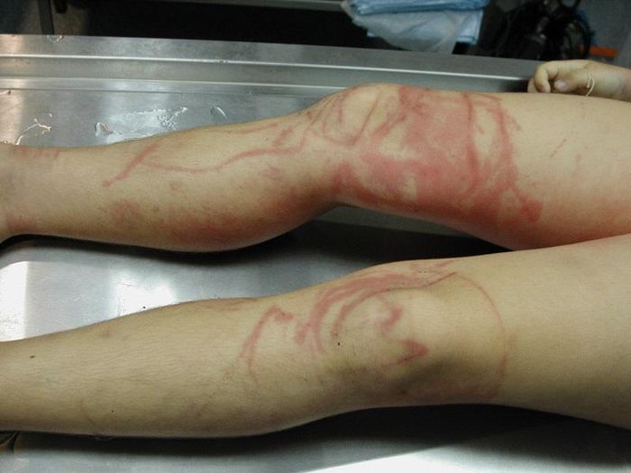 Bị sứa biển "cắn" tuyệt đối không được áp dụng các biện pháp dân gian truyền miệng để điều trị - Ảnh Internet