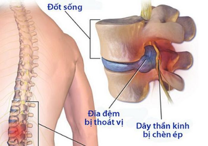Hình ảnh thoát vị đĩa đệm trên cộng hưởng từ.
