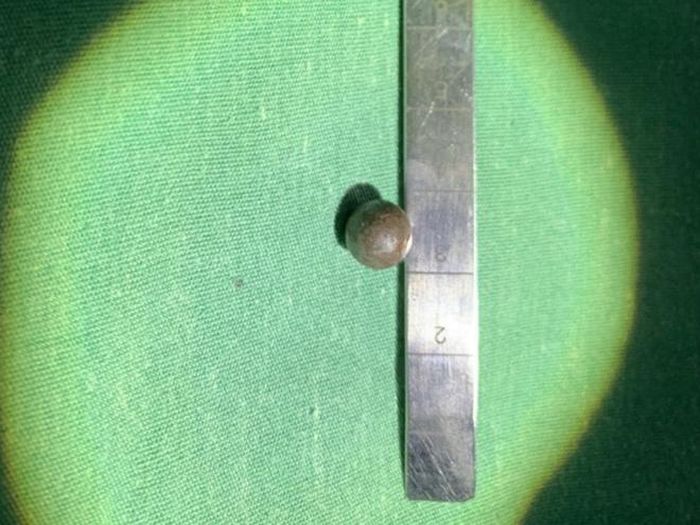 Viên đạn bi 8mm được các BS lấy ra khỏi đốt sống của bệnh nhân.