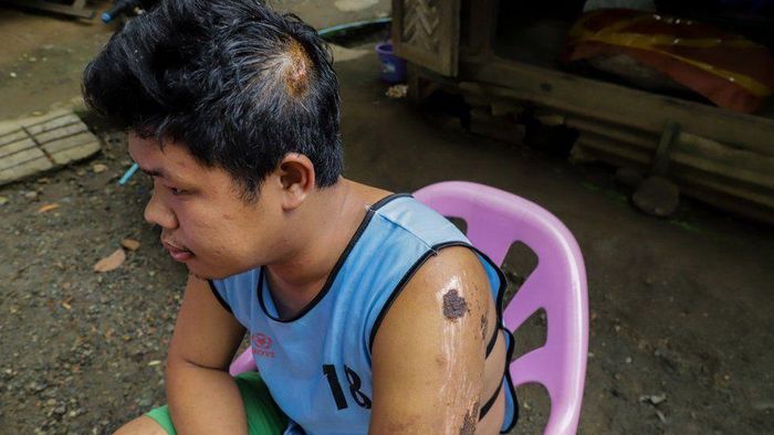  Yan Naing Myo may mắn thoát chết, nhưng phải chịu nhiều vết thương sau vụ lở đất. Ảnh: BBC. 