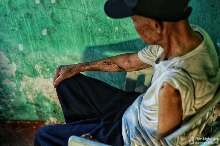 Vừa chữa bệnh, vừa lo mưu sinh, lại chống chọi với dịch bệnh, cuộc sống của những bệnh nhân chạy thận trở nên ngặt nghèo hơn trong mùa dịch Covid-19. Ảnh: Hải Vương