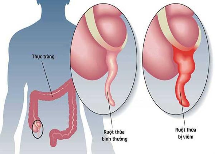 Thực hiện phẫu thuật nội soi để điều trị viêm ruột thừa - Ảnh Internet
