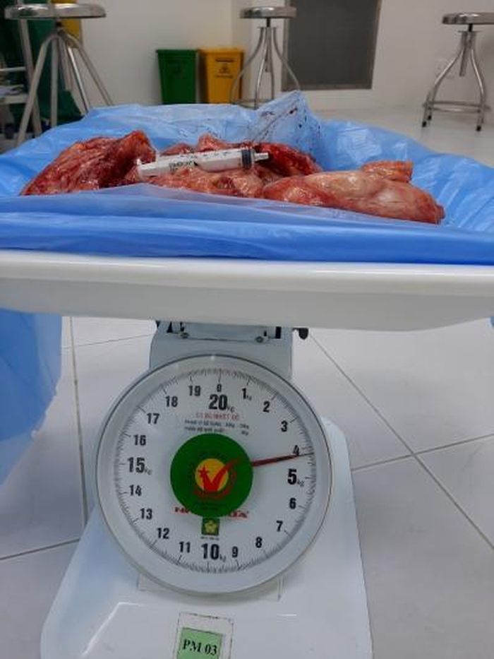 Khối u nặng hơn 4kg đã được phẫu thuật cắt bỏ
