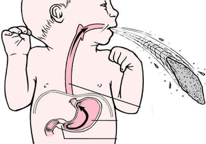 Hẹp phì đại môn vị gây ọc sữa ở trẻ (Ảnh: Internet)