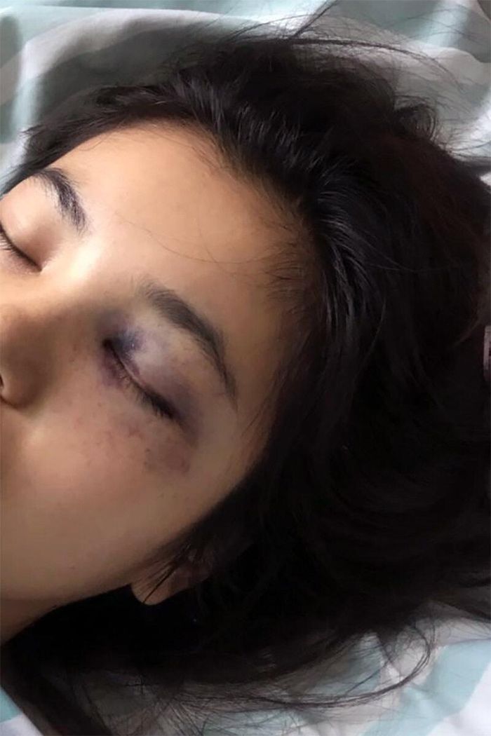  Cô Lưu trong bệnh viện sau khi bị chồng đánh đập tại cửa hàng. Ảnh: Nhân vật cung cấp/New York Times. 