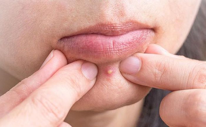 Cằm:Nổi mụn ở cằm là do mất cân bằng nội tiết tố. Bạn nên xây dựng thói quen ngủ đủ giấc, đều đặn, chế độ ăn uống lành mạnh. Ngoài ra, bạn có thể bổ sung trà bạc hà, omega-3 để giảm mụn ở cằm.