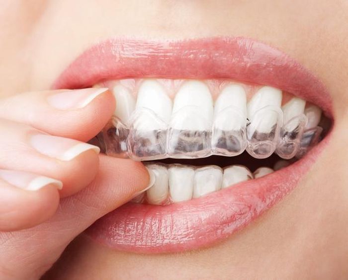  Tẩy trắng là phương pháp giúp cải thiện tình trạng răng ố vàng. Ảnh: Familydentalcare. 