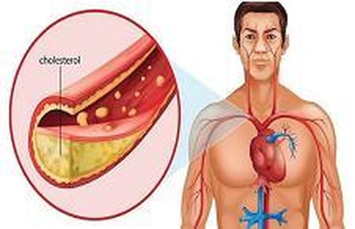 Nồng độ cholesterol cao có thể dẫn đến bệnh nhồi máu cơ tim.