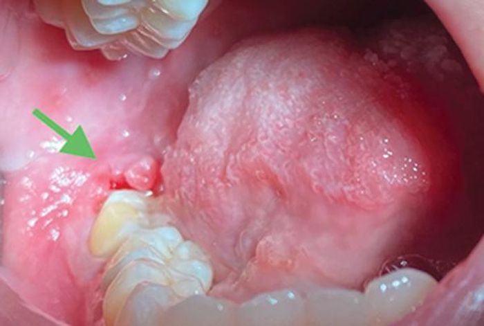 Răng mọc lệch dễ gây nhồi nhét thức ăn