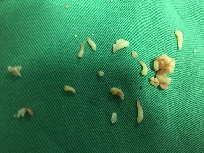 Gần 20 chiếc răng nhỏ được lấy ra trong khối u. Ảnh: BVCC.