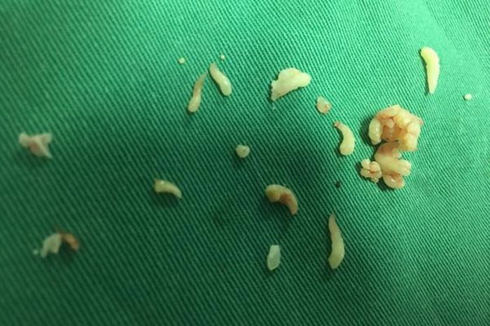 Số răng nhỏ trong khối u được gắp ra
