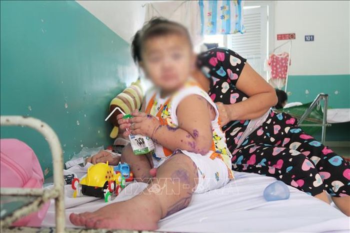 Một bệnh nhi mắc tay chân miệng được điều trị tại Bệnh viện Nhi đồng 2. Ảnh: Đinh Hằng.