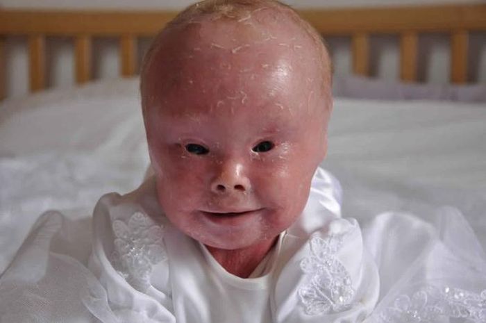  Trẻ mắc bệnh Harlequin ichthyosis thường có mí mắt quay ngược từ trong ra ngoài, mắt không nhắm, môi bị kéo chặt. Ảnh: Healthjade. 