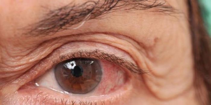 Dấu hiệu mắt bị mắc phải Glaucoma (cườm nước)