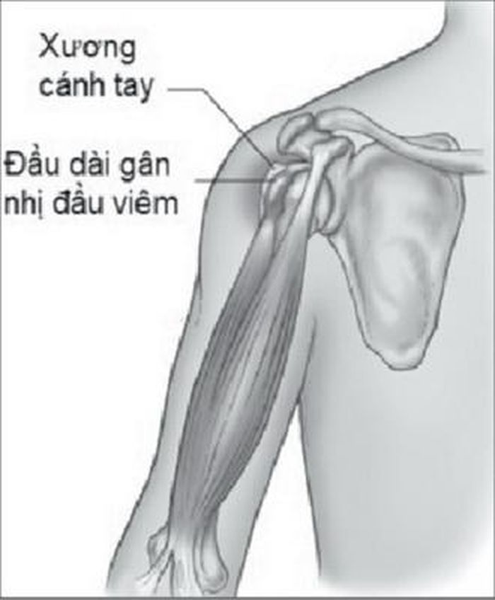 Tổn thương gân nhị đầu là 1 nguyên nhân gây viêm khớp vai.