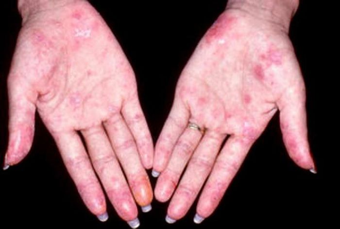 Bệnh lupus ban đỏ.