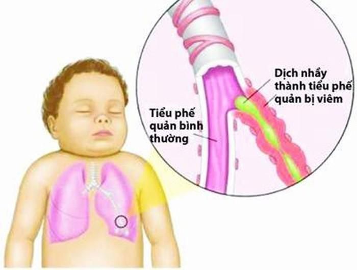 Viêm phế quản. Viêm phế quản là tình trạng viêm niêm mạc ống phế quản. Bệnh thường do các loại virus tấn công hoặc biến chứng từ cảm lạnh, cúm. Trẻ bị viêm phế quản sẽ ho dai dẳng kéo dài trong vài tuần sau khi chứng viêm đã hết, thở khò khè, sốt, ớn lạnh, sổ mũi, mệt mỏi, tức ngực.