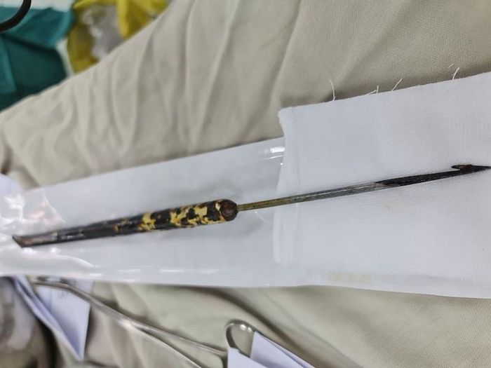 Mũi chĩa có ngạnh đâm sâu 10cm xuyên thủng phổi, cơ hoành, gan của bệnh nhân (ảnh: BVCC)