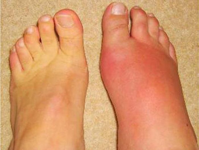 Bệnh gút gây sưng , đau ở các khớp.