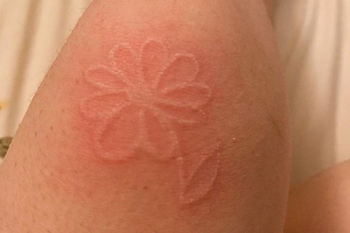 Nếu dùng một vật đầu tù vẽ hình thù tùy ý trên da, vài phút sau, trên bề mặt da đó sẽ nổi hình vẽ đấy lên như một hình xăm