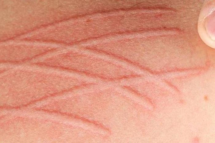 Khi mắc chứng da vẽ nổi, người bệnh sau khi cọ xước da thì tại vị trí đó sẽ nổi lên đường màu hồng, đỏ theo đúng vết xướng, mức độ tác động. Đồng thời, khu vực vết nổi sẽ có cảm giác ngứa ngáy, khó chịu, thậm chí là sưng, viêm