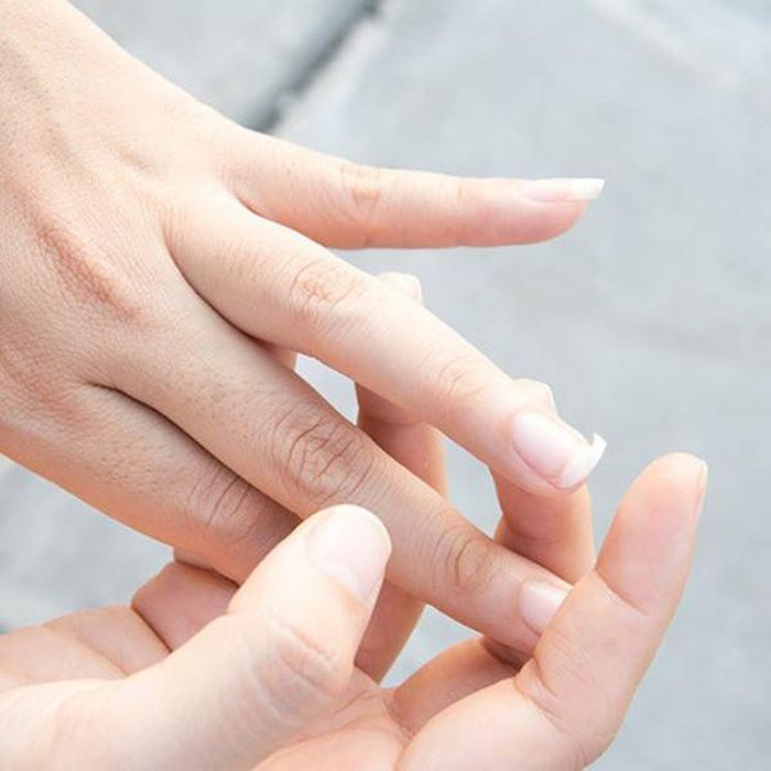 Móng tay gãy do mỏng và mềm, cách giải quyết duy nhất là cắt bỏ phần móng này.