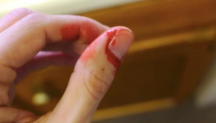 Xử lý vết thương trước để tránh nhiễm trùng, sau đó hạn chế đụng nước để mau lành, sau đó là cắt đi phần móng bị gãy.